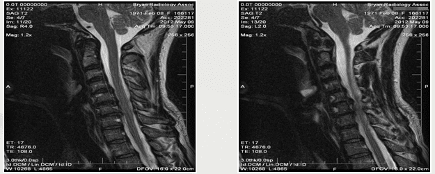 Spinal X-Ray